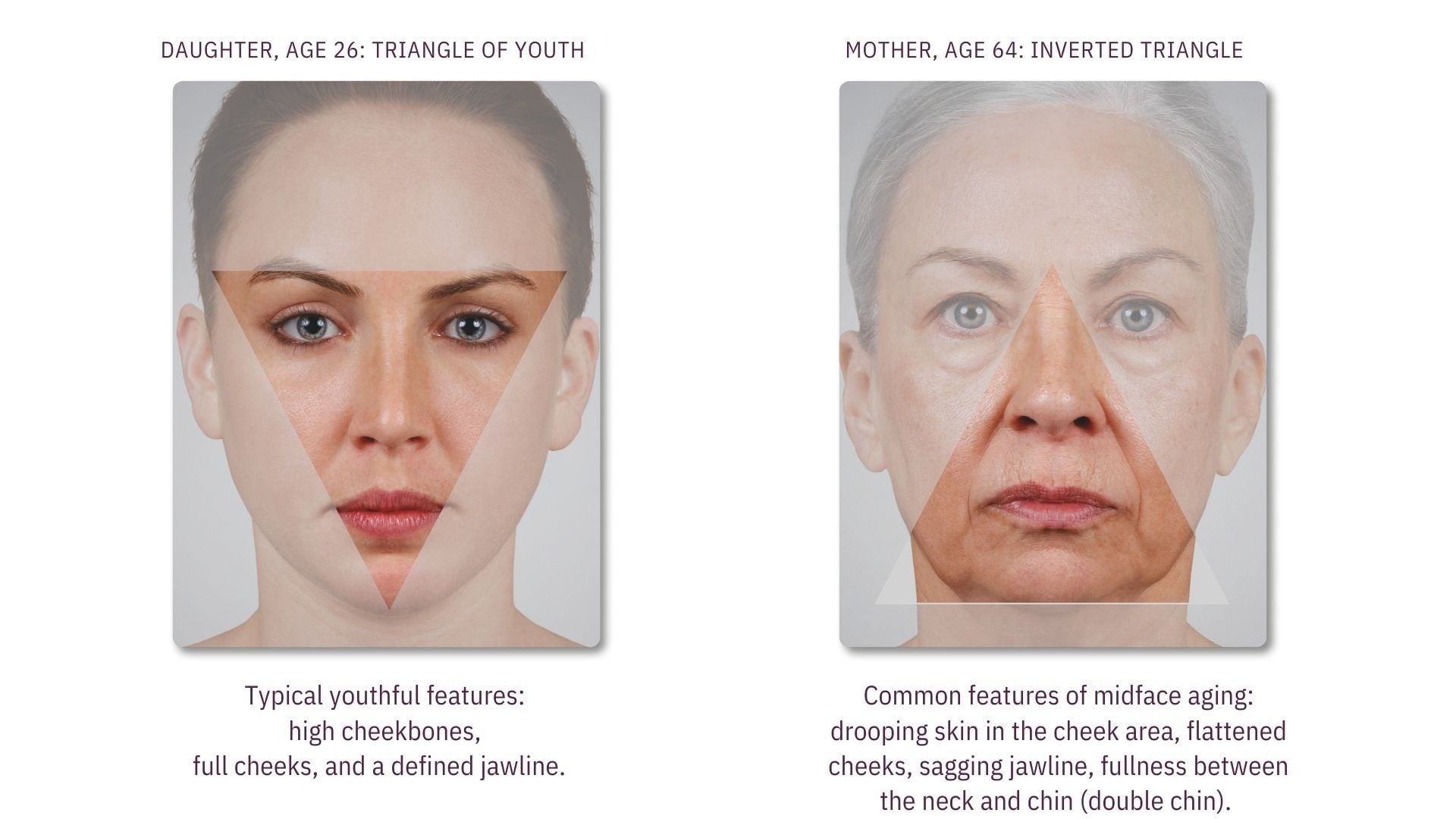 Facial Aging - The Triangle of Beauty